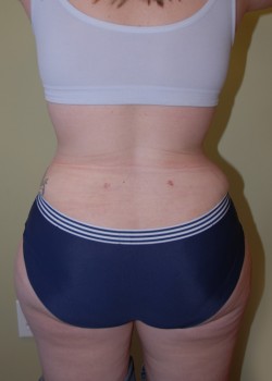 After Image: Liposuction Love Handles - back