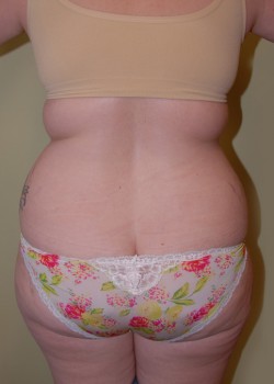 Before Image: Liposuction Love Handles - back