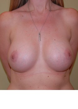 After Image: Breast Augmentation - front