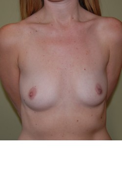 Before Image: Breast Augmentation - front
