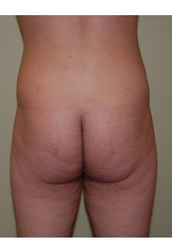 After Image: Liposuction Love Handles - front