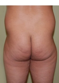 Before Image: Liposuction Love Handles - front