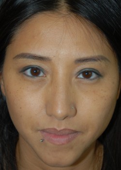 After Image: Asian Double Eyelid - front