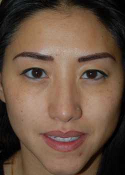 Before Image: Asian Double Eyelid - front