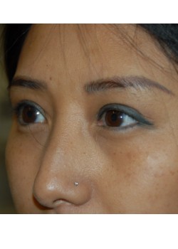 After Image: Asian Double Eyelid - left-front-oblique