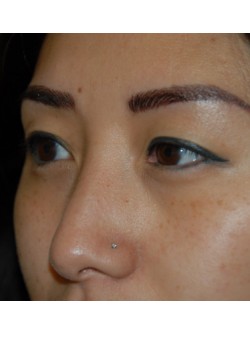 Before Image: Asian Double Eyelid - left-front-oblique