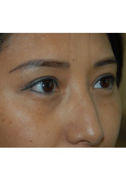 After Image: Asian Double Eyelid - right-front-oblique