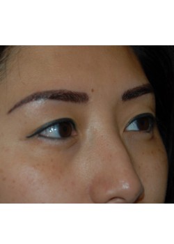 Before Image: Asian Double Eyelid - right-front-oblique