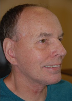 After Image: Face Lift and Neck Lift - right-front-oblique