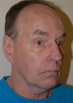 Before Image: Face Lift and Neck Lift - right-front-oblique