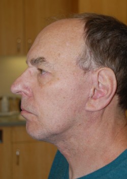 After Image: Face Lift and Neck Lift - other
