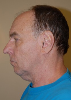 Before Image: Face Lift and Neck Lift - other
