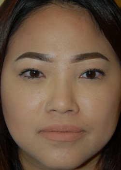 After Image: Asian Double Eyelid - front
