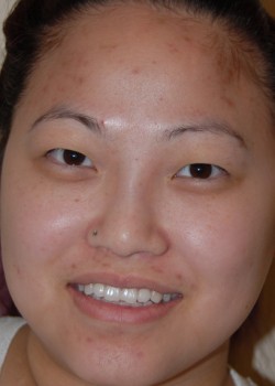 Before Image: Asian Double Eyelid - front