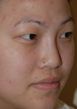 Before Image: Asian Double Eyelid - right-front-oblique