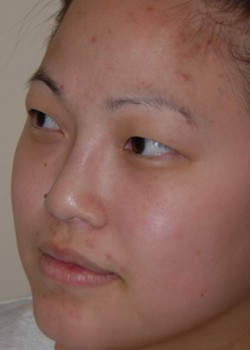 Before Image: Asian Double Eyelid - left-front-oblique