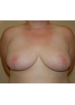 After Image: Breast Reduction - front