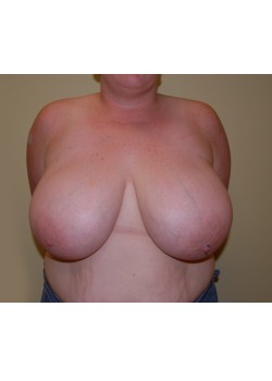 Before Image: Breast Reduction - front