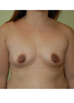 Before Image: Breast Augmentation - front