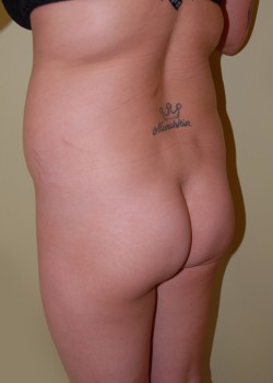 Before Image: Brazilian Butt Lift - left-front-oblique