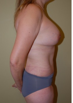 After Image: Tummy Tuck, Liposuction, Breast Augmentation - other