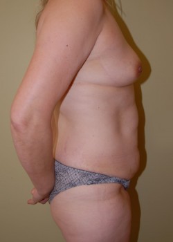 Before Image: Tummy Tuck, Liposuction, Breast Augmentation - other