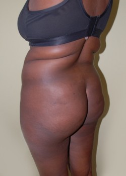 Before Image: Brazilian Butt Lift - left-front-oblique