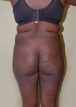 Before Image: Liposuction Love Handles and Back - front