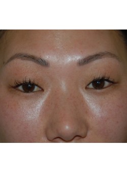 Before Image: Asian Double Eyelid - front