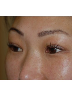 After Image: Asian Double Eyelid - left-front-oblique