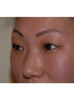 Before Image: Asian Double Eyelid - left-front-oblique