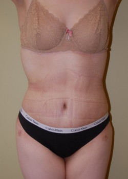 After Image: Tummy Tuck, Liposuction - front
