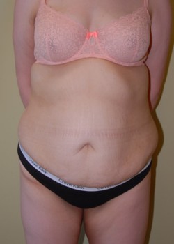 Before Image: Tummy Tuck, Liposuction - front