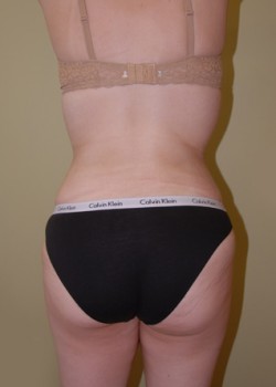 After Image: Liposuction Abdomen and Love Handles - front
