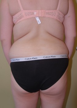 Before Image: Liposuction Abdomen and Love Handles - front