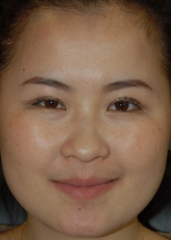After Image: Asian Double Eyelid - front