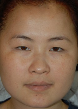 Before Image: Asian Double Eyelid - front