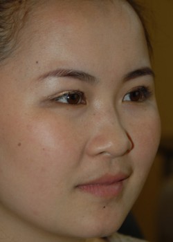 After Image: Asian Double Eyelid - right-front-oblique