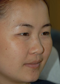 Before Image: Asian Double Eyelid - right-front-oblique