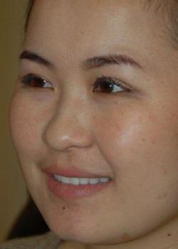 After Image: Asian Double Eyelid - left-front-oblique