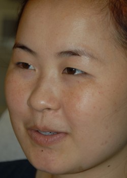 Before Image: Asian Double Eyelid - left-front-oblique