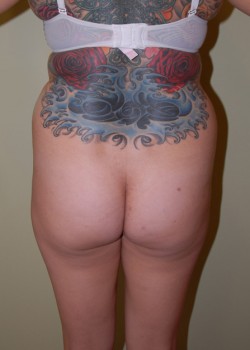 Before Image: Brazilian Butt Lift - back