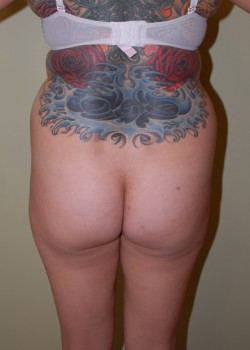 Before Image: Liposuction Abdomen, Love Handles, and Back - back