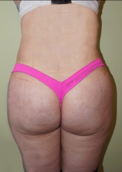 After Image: Liposuction Abdomen, Love Handles, and Back - back