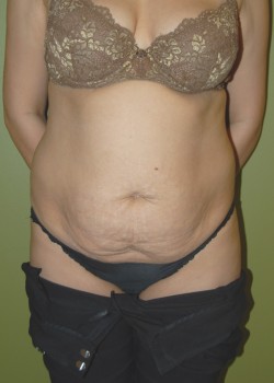 Before Image: Tummy Tuck, Liposuction - front