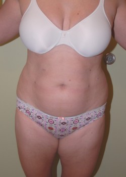 Before Image: Tummy Tuck, Liposuction - front