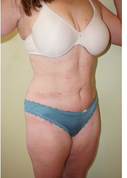 After Image: Tummy Tuck, Liposuction - right-front-oblique