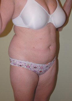 Before Image: Tummy Tuck, Liposuction - right-front-oblique