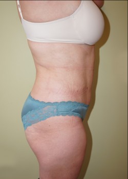 After Image: Tummy Tuck, Liposuction - other