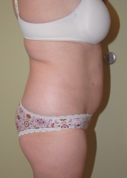 Before Image: Tummy Tuck, Liposuction - other